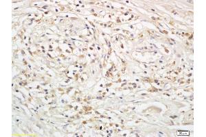 Formalin-fixed and paraffin embedded human rectal cancer labeled with Anti-Snail/SNAI 1 Polyclonal Antibody, Unconjugated (ABIN685597) followed by conjugation to the secondary antibody and DAB staining (SNAI1, SNAI2, SNAI3 (AA 188-264) 抗体)