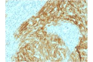 Formalin-fixed, paraffin-embedded human Follicular Dendritic Cell Sarcoma stained with CD21 / CR2 Mouse Monoclonal Antibody (CR2/1952). (CD21 抗体  (AA 44-196))