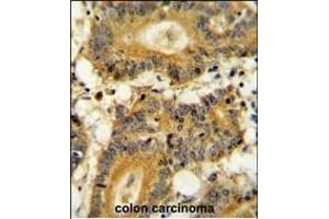 RPS6KA1 Antibody (ABIN654115 and ABIN2843994) immunohistochemistry analysis in formalin fixed and paraffin embedded human colon carcinoma followed by peroxidase conjugation of the secondary antibody and DAB staining. (RPS6KA1 抗体)