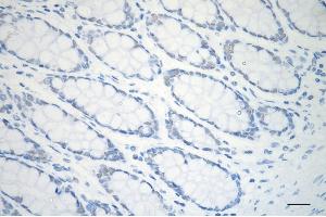 Immunohistochemistry was performed on paraffin-embedded human sigmoid colon carcinoma using ARID1A antibody (ABIN7797666), 1:200). (Recombinant ARID1A 抗体)