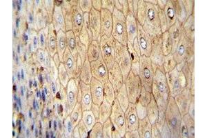 Beta-Actin antibody immunohistochemistry analysis in formalin fixed and paraffin embedded human esophageal carcinoma. (beta Actin 抗体)
