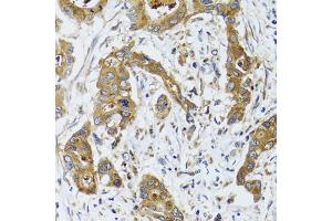 Immunohistochemistry of paraffin-embedded human colon carcinoma using BLZF1 antibody (ABIN2561429) at dilution of 1:100 (40x lens). (BLZF1 抗体)