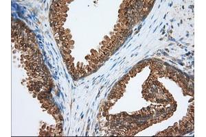 Immunohistochemical staining of paraffin-embedded Adenocarcinoma of Human ovary tissue using anti-PDE4A mouse monoclonal antibody. (PDE4A 抗体)