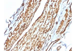 Formalin-fixed, paraffin-embedded human Testicular Carcinoma stained with VCL Mouse Monoclonal Antibody (VCL/2575). (Vinculin 抗体  (AA 174-322))