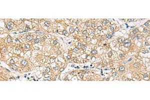 Immunohistochemistry of paraffin-embedded Human liver cancer tissue using DACT3 Polyclonal Antibody at dilution of 1:70(x200) (DACT3 抗体)