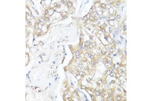 Immunohistochemistry of paraffin-embedded human liver cancer using Smad7 antibody (ABIN7270356) at dilution of 1:100 (40x lens). (SMAD7 抗体  (AA 1-100))