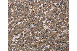 Immunohistochemistry of Human liver cancer using CAB39 Polyclonal Antibody at dilution of 1:40 (CAB39 抗体)