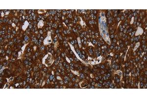 Immunohistochemistry of paraffin-embedded Human ovarian cancer tissue using KISS1R Polyclonal Antibody at dilution 1:30 (KISS1R 抗体)
