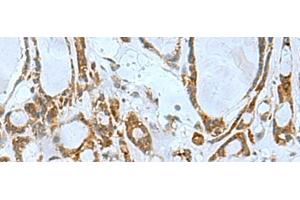 Immunohistochemistry of paraffin-embedded Human thyroid cancer tissue using TSGA10 Polyclonal Antibody at dilution of 1:50(x200) (TSGA10 抗体)