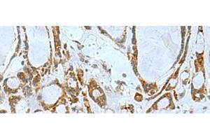 Immunohistochemistry of paraffin-embedded Human thyroid cancer tissue using TSGA10 Polyclonal Antibody at dilution of 1:50(x200) (TSGA10 抗体)