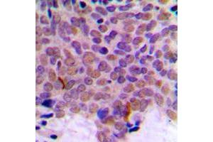 Immunohistochemical analysis of CLK1 staining in human breast cancer formalin fixed paraffin embedded tissue section. (CLK1 抗体  (Center))