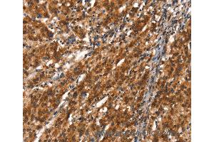 Immunohistochemistry of Human thyroid cancer using CYP2D6 Polyclonal Antibody at dilution of 1:40 (CYP2D6 抗体)