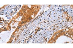 Immunohistochemistry of paraffin-embedded Human cervical cancer using CDK19 Polyclonal Antibody at dilution of 1:70 (CDK19 抗体)