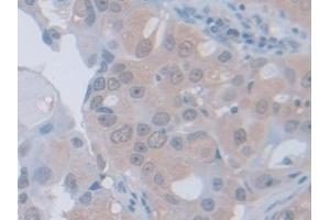 Detection of PGM1 in Human Breast cancer Tissue using Polyclonal Antibody to Phosphoglucomutase 1 (PGM1)