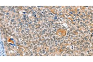 Immunohistochemistry of paraffin-embedded Human cervical cancer using ALDOB Polyclonal Antibody at dilution of 1:40 (ALDOB 抗体)