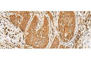 Immunohistochemistry of paraffin-embedded Human esophagus cancer tissue using PPOX Polyclonal Antibody at dilution of 1:30(x200) (PPOX 抗体)