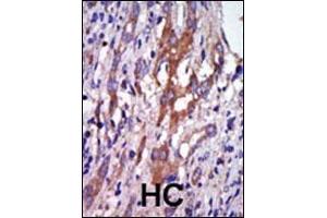 Formalin-fixed and paraffin-embedded human cancer tissue reacted with the primary antibody, which was peroxidase-conjugated to the secondary antibody, followed by DAB staining. (Aurora A 抗体  (N-Term))