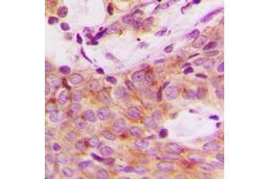 Immunohistochemical analysis of S6K1 (pS447) staining in human breast cancer formalin fixed paraffin embedded tissue section.
