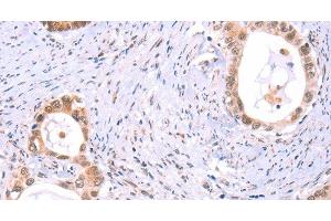 Immunohistochemistry of paraffin-embedded Human cervical cancer tissue using PROS1 Polyclonal Antibody at dilution 1:60 (PROS1 抗体)