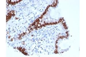 Formalin-fixed, paraffin-embedded human colon carcinoma stained with CDX2 Recombinant Mouse Monoclonal Antibody (rCDX2/6921). (Recombinant CDX2 抗体)