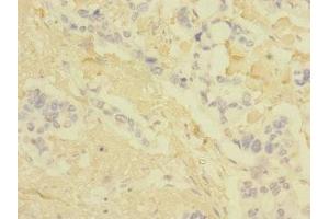 Immunohistochemistry of paraffin-embedded human pancreatic cancer using ABIN7147896 at dilution of 1:100 (Claudin 18 抗体  (AA 20-80))
