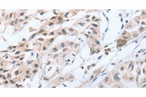 Immunohistochemistry of paraffin-embedded Human lung cancer tissue using CHRNA10 Polyclonal Antibody at dilution 1:50 (CHRNA10 抗体)