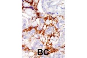 Formalin-fixed and paraffin-embedded human cancer tissue reacted with the primary antibody, which was peroxidase-conjugated to the secondary antibody, followed by AEC staining. (PAK3 抗体  (AA 218-247))