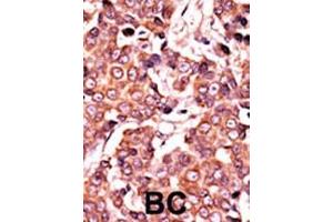 Formalin-fixed and paraffin-embedded human cancer tissue reacted with the primary antibody, which was peroxidase-conjugated to the secondary antibody, followed by AEC staining. (CDC25A 抗体  (pSer278))