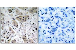 Immunohistochemical analysis of paraffin- embedded breast carcinoma, using Akt (Phospho-Ser473) Antibody. (AKT1 抗体  (pSer473))