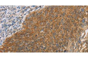 Immunohistochemistry of paraffin-embedded Human cervical cancer tissue using ERK 3 Polyclonal Antibody at dilution 1:40 (MAPK6 抗体)