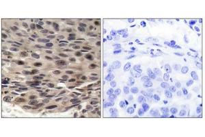 Immunohistochemical analysis of paraffin-embedded human breast carcinoma, using 4E-BP1 (phospho-Thr36) antibody.