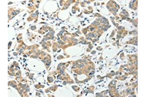 The image on the left is immunohistochemistry of paraffin-embedded Human colon cancer tissue using ABIN7191847(PFDN6 Antibody) at dilution 1/35, on the right is treated with synthetic peptide. (PFDN6 抗体)