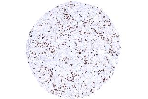 High Ki67 LI in a breast cancer NST (Ki-67 抗体  (AA 2293-2478))
