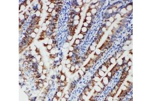 IHC-P: FER antibody testing of human intestinal cancer tissue (FER 抗体  (Middle Region))