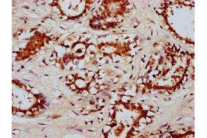 IHC image of ABIN7174060 diluted at 1:200 and staining in paraffin-embedded human breast cancer performed on a Leica BondTM system. (RYK 抗体  (AA 494-586))