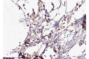 ABIN6276543 at 1/100 staining Human breast cancer tissue by IHC-P. (RALBP1 抗体  (N-Term))