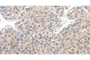 Immunohistochemistry of paraffin-embedded Human breast cancer tissue using SCN10A Polyclonal Antibody at dilution 1:25 (Nav1.8 抗体)