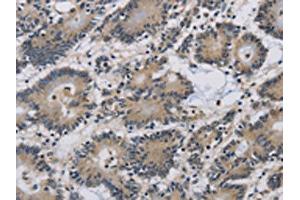 The image on the left is immunohistochemistry of paraffin-embedded Human colon cancer tissue using ABIN7191092(IMPAD1 Antibody) at dilution 1/20, on the right is treated with synthetic peptide. (IMPAD1 抗体)