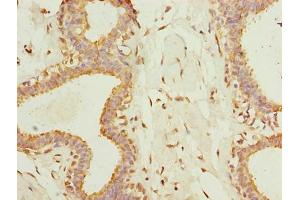 Immunohistochemistry of paraffin-embedded human breast cancer using ABIN7173083 at dilution of 1:100 (TMEM161A 抗体  (AA 29-98))