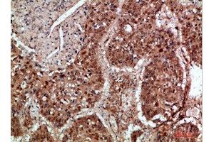 Immunohistochemical analysis of paraffin-embedded human-lung-cancer, antibody was diluted at 1:200 (TICAM1 抗体  (AA 663-712))