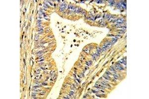 IHC analysis of FFPE human colon carcinoma stained with SOD1 antibody (SOD1 抗体  (AA 55-84))