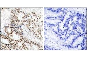 Immunohistochemistry analysis of paraffin-embedded human breast carcinoma, using BRCA1 (Phospho-Ser1423) Antibody. (BRCA1 抗体  (pSer1423))