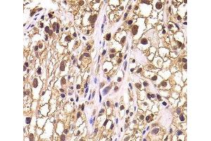 Immunohistochemistry of paraffin-embedded Human kidney cancer using TCEB3 Polyclonal Antibody at dilution of 1:100 (40x lens).
