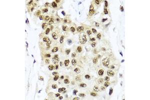 Immunohistochemistry of paraffin-embedded human lung cancer using TET2 antibody. (TET2 抗体)