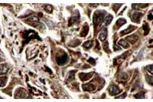 Immunohistochemistry of RFFL polyclonal antibody  shows strong cytoplasmic and membranous staining of tumor cells in cancerous human liver tissue. (RFFL 抗体  (AA 1-363))