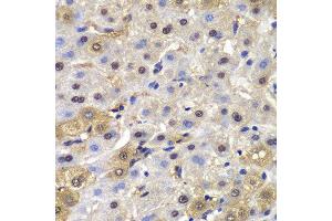 Immunohistochemistry of paraffin-embedded human liver cancer using MAD1L1 antibody. (MAD1L1 抗体  (AA 360-700))
