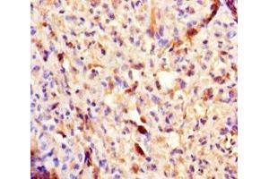 Immunohistochemistry of paraffin-embedded human melanoma using ABIN7154460 at dilution of 1:100