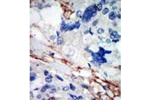 Formalin-fixed and paraffin-embedded human cancer tissue reacted with the primary antibody, which was peroxidase-conjugated to the secondary antibody, followed by DAB staining. (DYRK2 抗体  (N-Term))