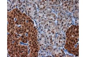 Immunohistochemical staining of paraffin-embedded Adenocarcinoma of colon tissue using anti-SRR mouse monoclonal antibody. (SRR 抗体)