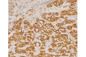 Immunohistochemical staining of human liver cancer tissue section with GOT2 monoclonal antibody, clone 14  at 1:100 dilution. (GOT2 抗体  (AA 225-430))